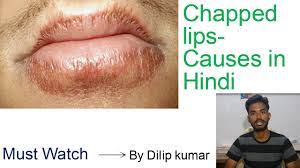 chapped lips causeuch more in