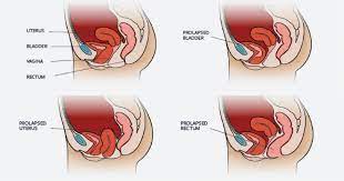 pelvic organ prolapse 5