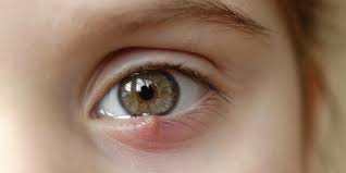 the most common eye infections
