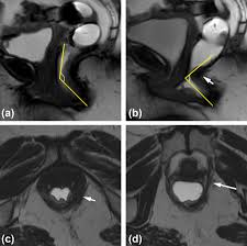 dynamic pelvic floor mri