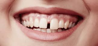 Treatment options for teeth gaps. Close Tooth Gaps Between Teeth Plano Tx Cosmetic Dentistry