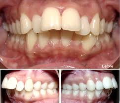 An overbite is a dental condition where there is overlapping of maxillary central incisors over the braces are commonly used to fix an overbite. What Is Overjet Symptoms Diagnosis And Orthodontic Treatment