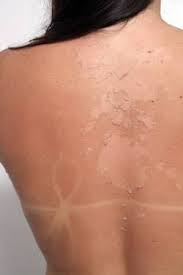 side effects of laser hair removal