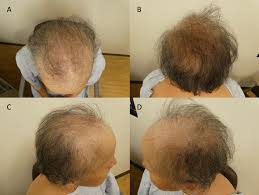 figure 2 minoxidil responsive alopecia following treatment of a t cancer female patient with taxane chemotherapy and adjuvant hormonal therapy