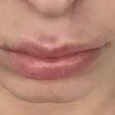 why is the area above my top lip very