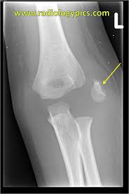 We have described a fracture dislocation of elbow in a 13 year old with associated medial epicondyle and lateral condyle fractures. Lateral Epicondyle Avulsion Fracture Radiologypics Com