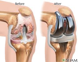 knee joint replacement series