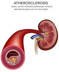 It occurs when the kidneys fail, preventing the body from removing. End Stage Renal Disease Guide Causes Symptoms And Treatment Options