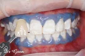 008 Tooth Whitening Bleaching Union Dental Surgery