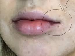 restylane refyne lip injections to heal