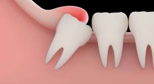 This will help to reduce the swelling, caused due to wisdom teeth growing in pain. Managing Wisdom Tooth Pain At Home Without Seeing A Dentist