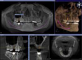 cone beam tomography 3d x ray