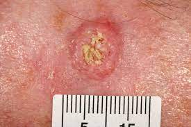 Find out how to spot the early signs of skin cancer. Non Melanoma Skin Cancers