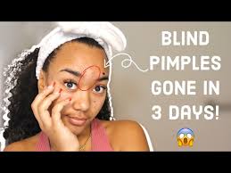 how to treat a blind pimple fast how