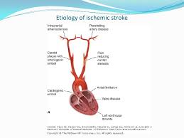 Approach To A Patient With Stroke Pathophysiology Of Stroke