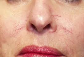 vbeam laser treatment for rosacea