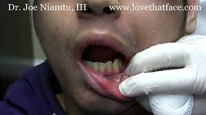 lip piercing removal piercings stuck in