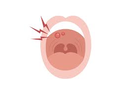 painful mouth sore symptoms causes