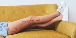 spider veins and varicose veins