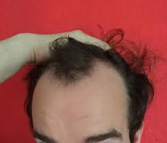 Geheimratsecken sind ein phänomen, das bei männern auftritt, deren haar immer lichter wird. Hohe Stirn Und Geheimratsecken Mann 24 Was Gibt Es Fur Passende Frisuren Haare Manner Frisur