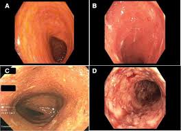 Ultrasonography, ulcerative colitis, colonoscopy, sensitivity, specicity. A Comprehensive Review And Update On Ulcerative Colitis Sciencedirect