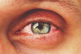 eye herpes causes treatment what