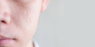 open pores on face causes treatment