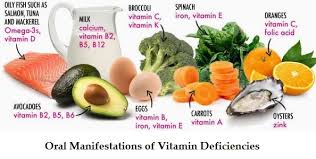 Oral Manifestation Or Signs And Symptoms Of Vitamin Deficiency