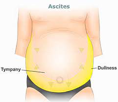 home remes for ascites natural