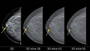 What Is Breast Tomosynthesis Arya Stana Bone Breast Care