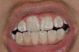 your teeth balsall common dental