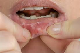 mouth sores images