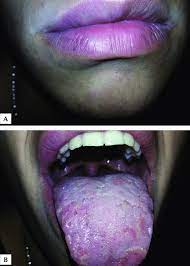 upper lip swelling