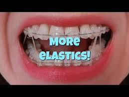Overbite is a vertical overlapping of the top and the lower teeth. Open Overbite My Braces Story Part 1 Youtube Braces Elastics Braces Overbite Braces
