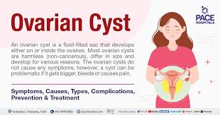 ovarian cyst symptoms causes types