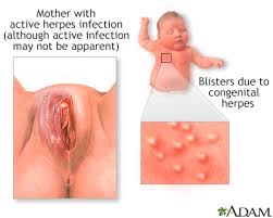 pregnancy and herpes information