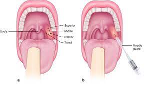 drainage of peritonsillar abscess