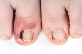 ingrown nails usually occor on the big toe