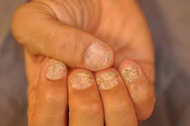 trachyonychia rough nails