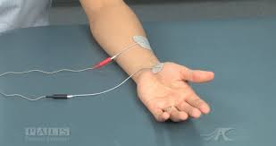 Best Electrode Placement For Arm And Hand Stroke