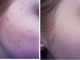 reddit user rid herself of acne scars