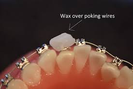 If you've never used dental wax before, then read following: Ortho Care From Home Sayre Orthodontics Bozeman Mt