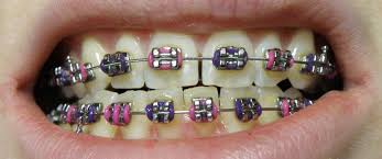 This involves reshaping the mouth by applying persistent pressure that shifts the teeth closer. Dental Braces Wikipedia