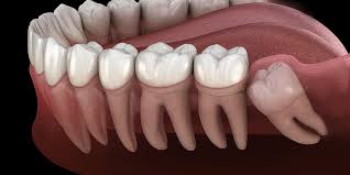 After removal of these large molar teeth at the back of the mouth, the gums and bone will take some time to fully heal, and the soft tissue may be sensitive for a few weeks. How Long Does It Take For Wisdom Teeth To Heal Dentistry By Design