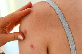 treatment for actinic keratosis at