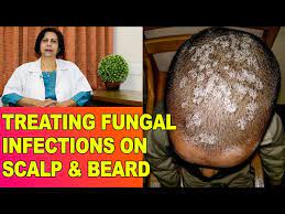 fungal fangal infections itching in
