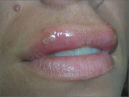 ulcers on upper lip mdedge family
