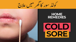 cold sore home remes hash