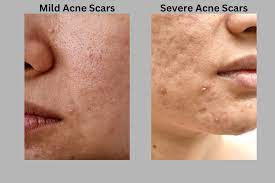 erase acne scars with prp microneedling