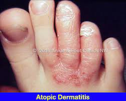 atopic dermais treatment foot